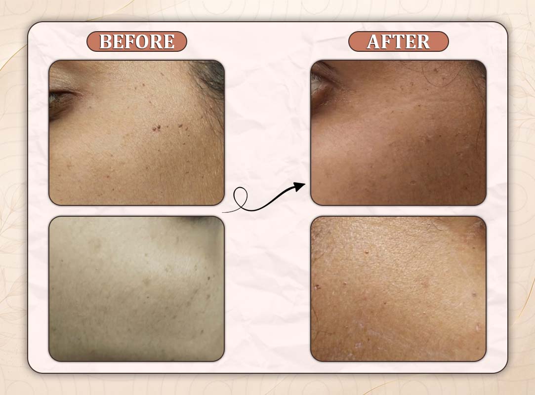Treatment Result 11