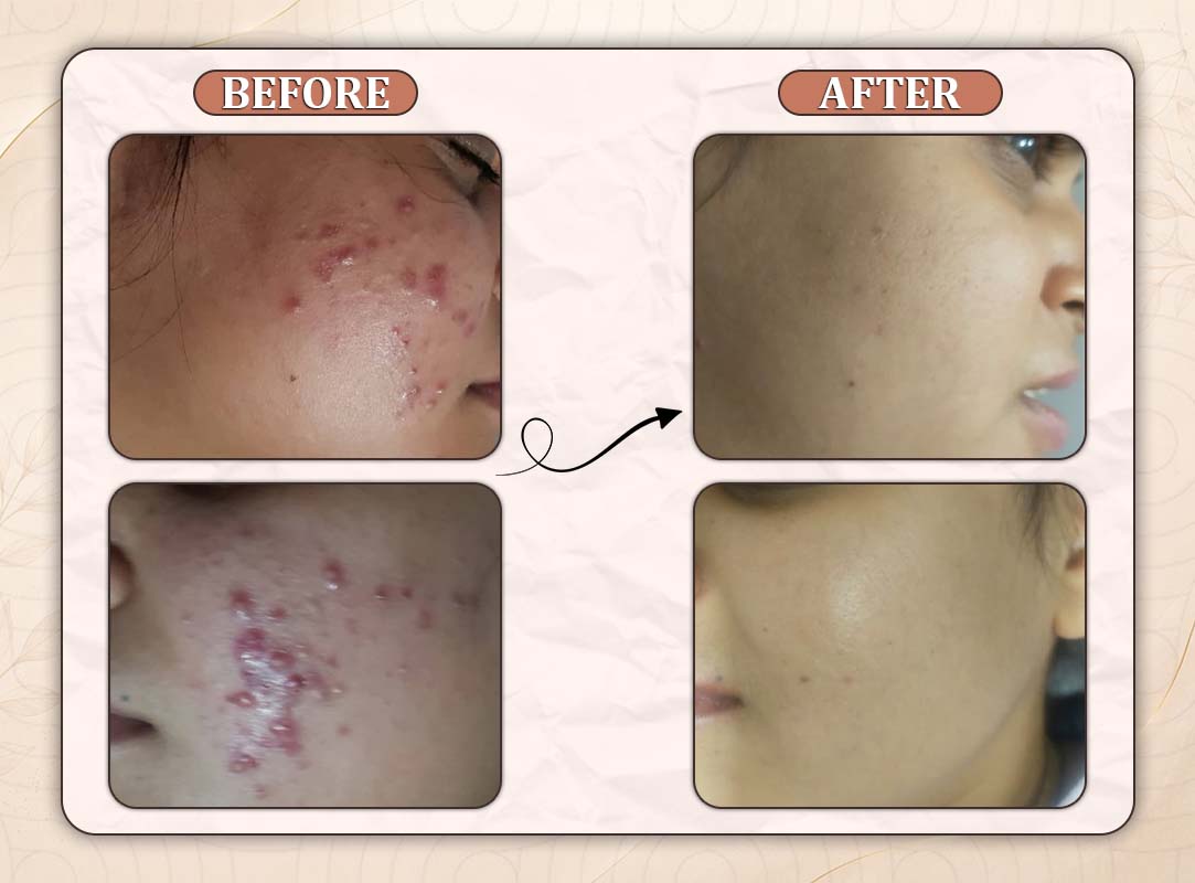 Treatment Result 14